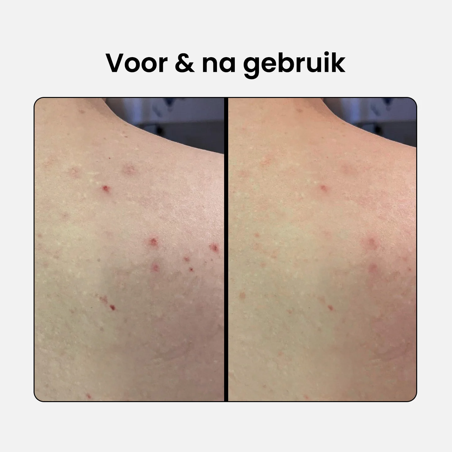 2% BHA Exfoliating Body Spray - Image 4